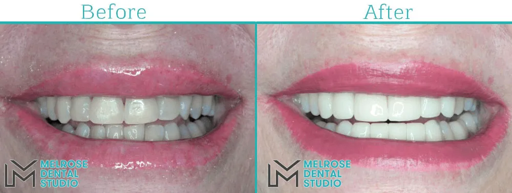 Smile makeover with porcelain veneers at Melrose Dental Studio, before and after, case 4